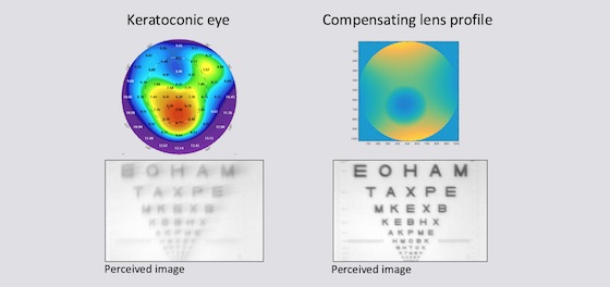 Athens Eye Hospital - Innovation: W-Lens project.