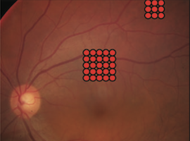 Για πρώτη φορά στην Ελλάδα, εφαρμογή Micro Pulse Yellow Laser για τη θεραπεία διαβητικού οιδήματος ωχράς κηλίδος και κεντρικής ορώδους αμφιβληστοειδοπάθειας